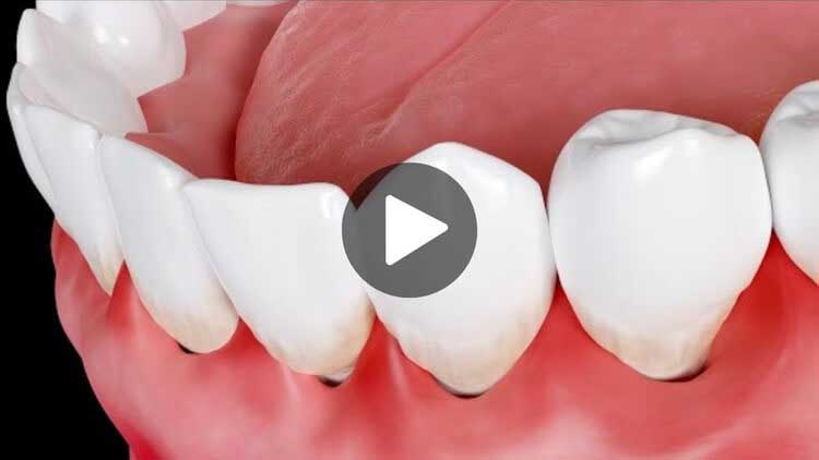 A thumbnail for an educational video on swollen gums